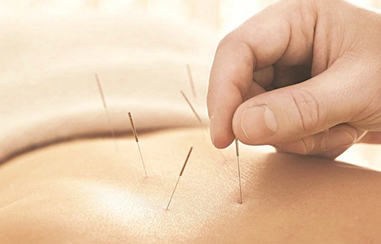Kỹ thuật Điện mãng châm theo y học cổ truyền